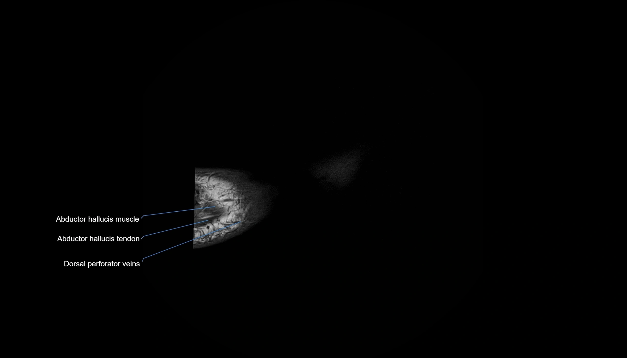 MRI mid foot sagittal cross sectional anatomy 3T  radiology  image-img-00001-00042.webp